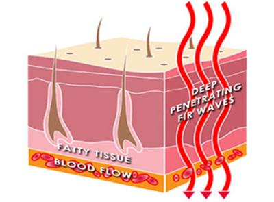 Deep Penetrating Therapeutic Heat