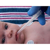 Little Sucker® Standard Style Suction Device, Oral and Nasal Type #N205