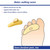 Pedifix® Right Hammer Toe Crest, Small #8154B-SR