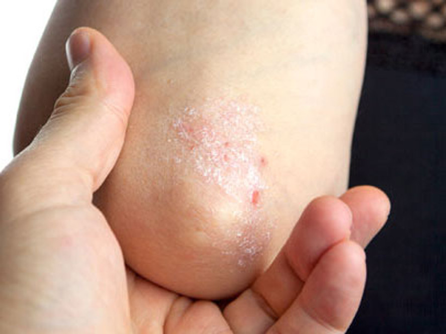 eczema on elbows