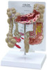 Colon Cancer  model