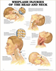 Whiplash Injuries of the Head and Neck, chiropractic wall chart, wall chart, anatomy chart, anatomical, anatomical chart, anatomical chart company, anatomical charts, anatomical diagram, anatomical human, anatomical human body, anatomical illustrations, anatomical images, anatomical muscle, anatomical physiology, anatomical picture, anatomical poster, anatomical wall chart, anatomy chart, anatomy poster, Head and Neck Chart, Head and Neck Poster
