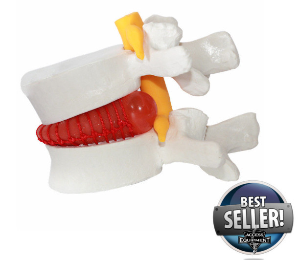 Looking for a Decompression Spinal Disc Herniation Demonstration Model, Spinal Disc Herniation Demonstration Model, Decompression Spine Disc Herniation Demonstration Model, Spine Disc Herniation Demonstration Model, Decompression Disc Herniation Model, Demonstration Model Disc Herniation, Disc Herniation, Disc Herniation Model, Anatomical Model, Spinal Model?