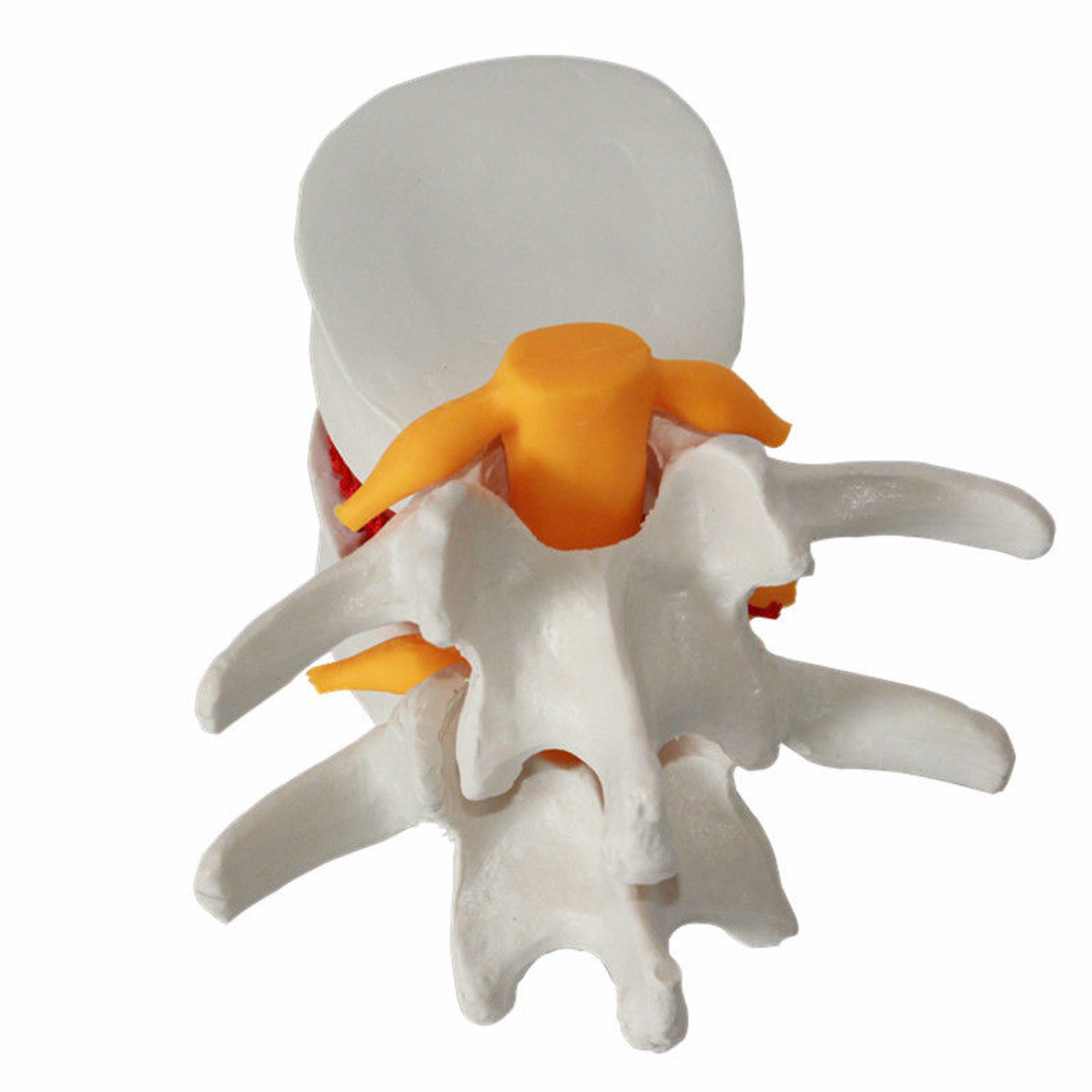 Looking for a Decompression Spinal Disc Herniation Demonstration Model, Spinal Disc Herniation Demonstration Model, Decompression Spine Disc Herniation Demonstration Model, Spine Disc Herniation Demonstration Model, Decompression Disc Herniation Model, Demonstration Model Disc Herniation?