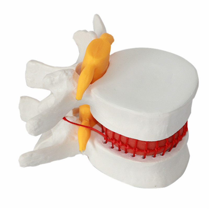 Looking for a Decompression Spinal Disc Herniation Demonstration Model, Spinal Disc Herniation Demonstration Model, Decompression Spine Disc Herniation Demonstration Model, Spine Disc Herniation Demonstration Model, Decompression Disc Herniation Model, Demonstration Model Disc Herniation, Disc Herniation, Disc Herniation Model, Anatomical Model, Spinal Model?