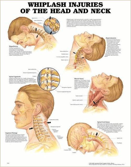 Whiplash Injuries of the Head and Neck, chiropractic wall chart, wall chart, anatomy chart, anatomical, anatomical chart, anatomical chart company, anatomical charts, anatomical diagram, anatomical human, anatomical human body, anatomical illustrations, anatomical images, anatomical muscle, anatomical physiology, anatomical picture, anatomical poster, anatomical wall chart, anatomy chart, anatomy poster, Head and Neck Chart, Head and Neck Poster
