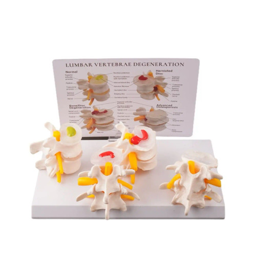 Decompression Educational Model Combo, 4 Stages of Degeneration, Decompression Spinal Disc Herniation Model, Degenerative Lumbar Vertebrae Disks Model, Decompression Educational Model, Decompression Educational Models, degenerative lumbar discs model, disc degeneration model, disc herniation model, Decompression Model, anatomical model Decompression Educational Model Combo, 4 Stages of Degeneration, Decompression Spinal Disc Herniation Model, Degenerative Lumbar Vertebrae Disks Model, Decompression Educational Model, Decompression Educational Models, degenerative lumbar discs model, disc degeneration model, disc herniation model, Decompression Model, anatomical model