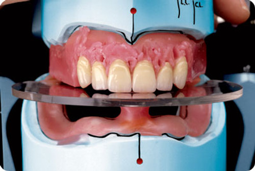 Occlusion Control Kit