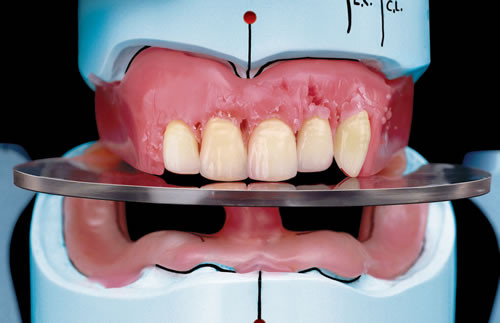 Denture Mold Kit