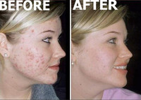 Blackhead Whitehead Acne Silver Extractor Skincare Powder Treatment