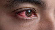 Itchy, Red, Watery Eyes? Here’s What Might Be Causing It