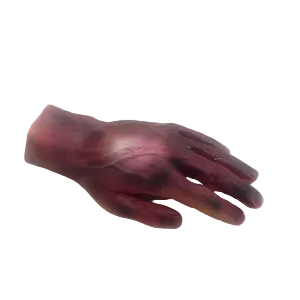 Nasco Burn Hand 2nd & 3rd Degree