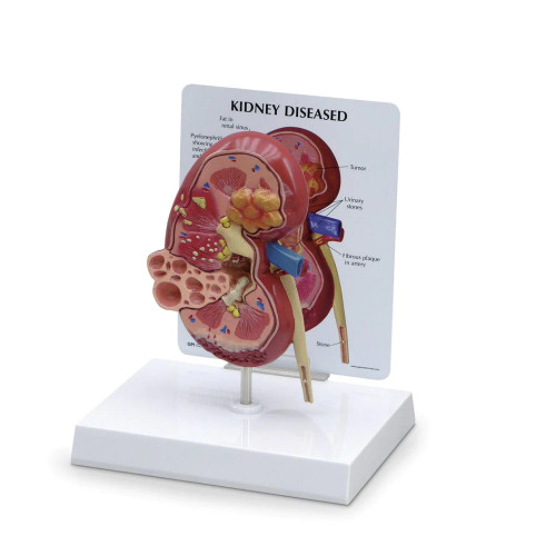 Kidney Model with Pathologies