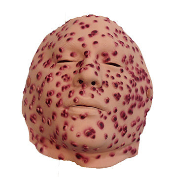 Nasco Smallpox Moulage, 8th–10th Day