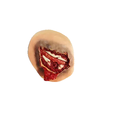 Nasco Open Rib Fracture