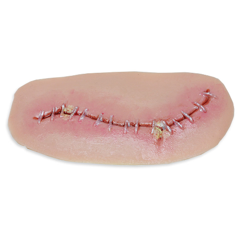 Nasco Level 1 Surgical Site Infection