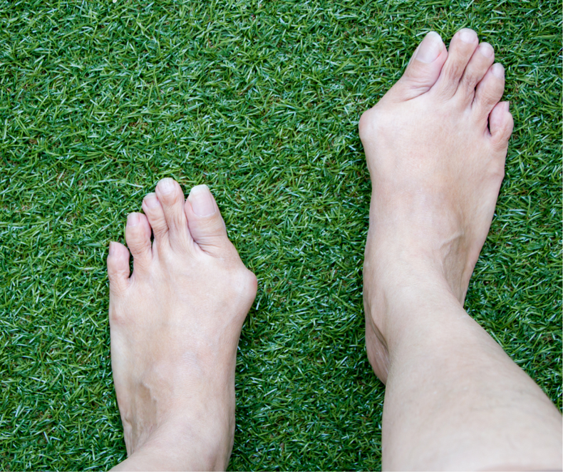 Understanding and Managing Hallux Valgus: Causes, Solutions, and Top Products