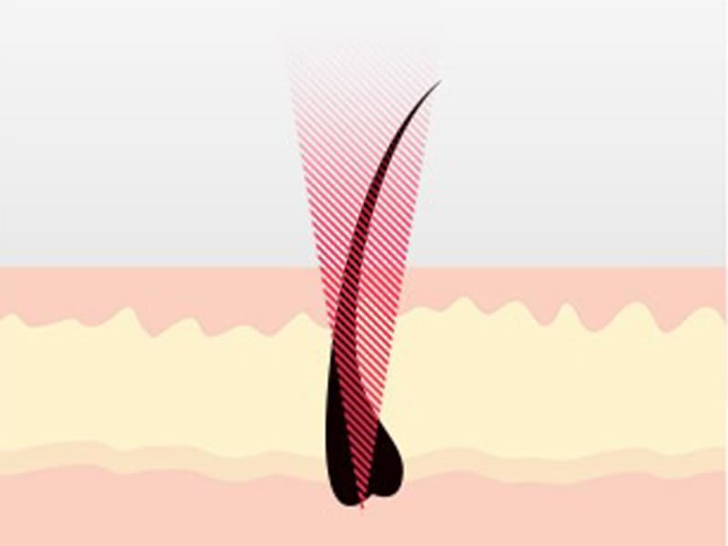 What is IPL hair removal? Differences to laser and how they both