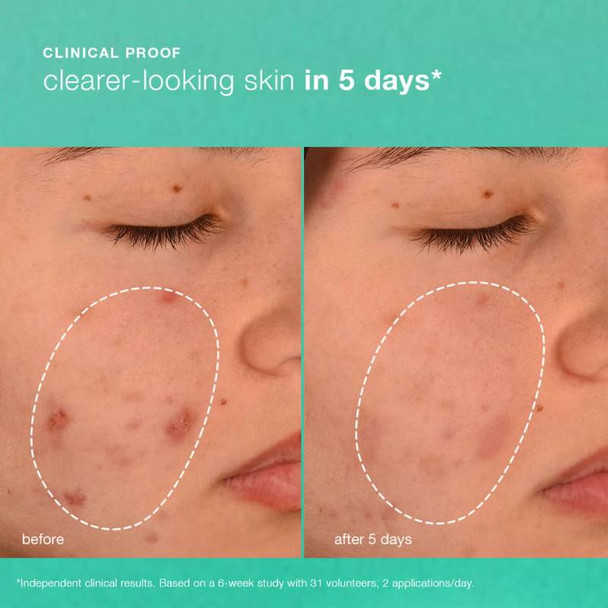 Dermalogica Active Clearing Breakout Biotic Moisturiser 50ml 4