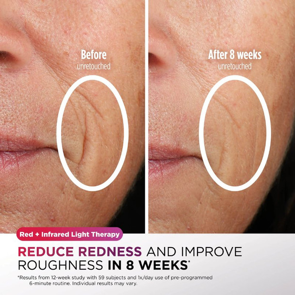 Shark CryoGlow LED Face Mask- Lilac Chill 5