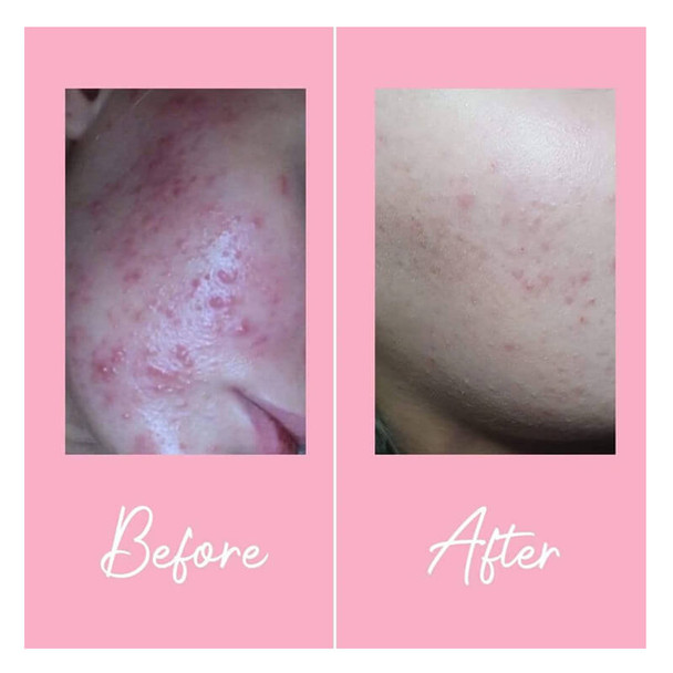 Skinician Revitalising Day Moisturiser 50ml Before and After