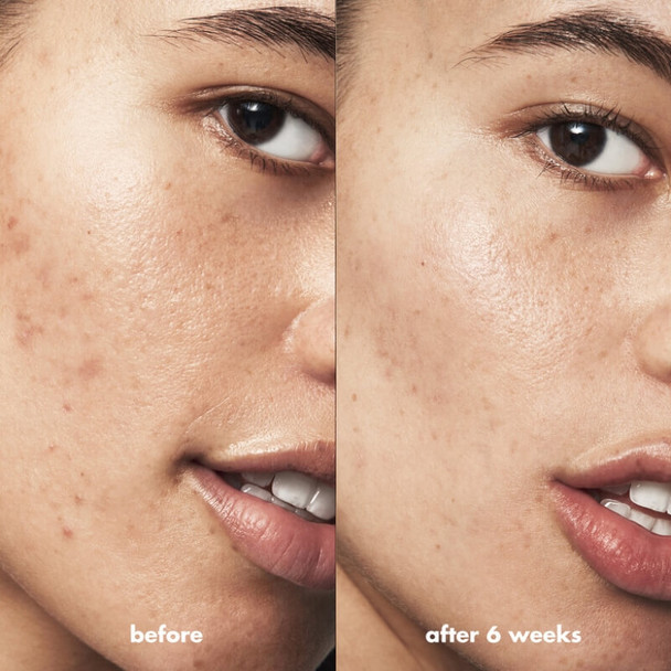 elf Blemish Breakthrough Gel anti-acné avant/après