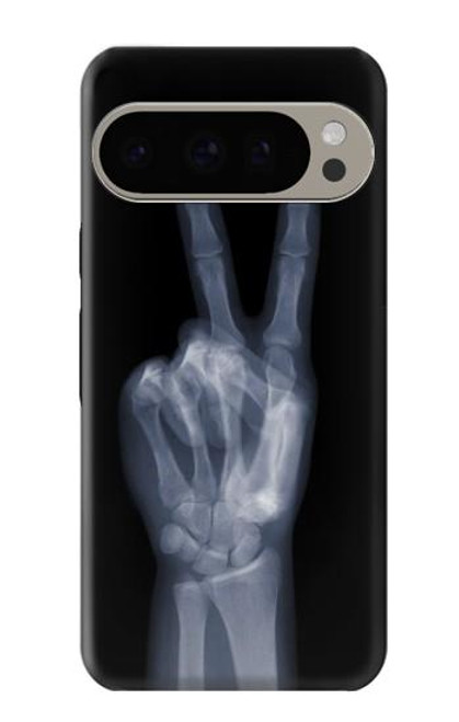 S3101 X-ray Peace Sign Fingers Case For Google Pixel 9 Pro