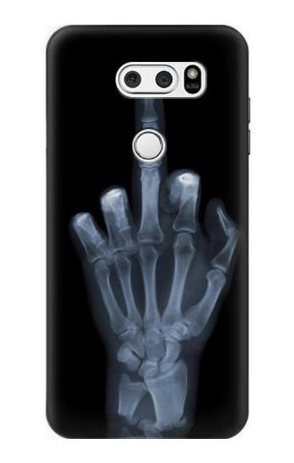 S1143 X-ray Hand Middle Finger Case For LG V30, LG V30 Plus, LG V30S ThinQ, LG V35, LG V35 ThinQ