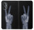 S3101 X-ray Peace Sign Fingers Case For OnePlus Nord N20 5G