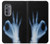 S3239 X-Ray Hand Sign OK Case For Motorola Edge (2022)