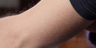 What is Keratosis Pilaris?