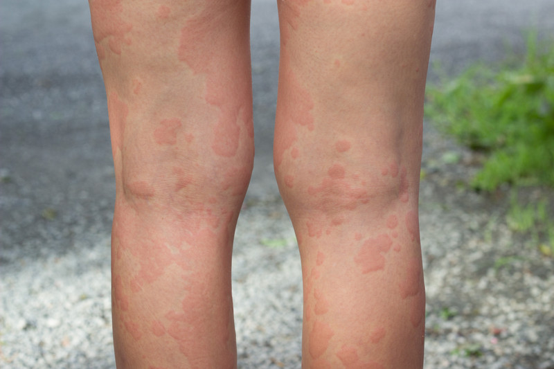 Products Which Could Help Remedy Hives