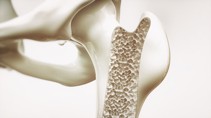 Tracking and Treating Chronic Diseases, Part IX: Osteoporosis
