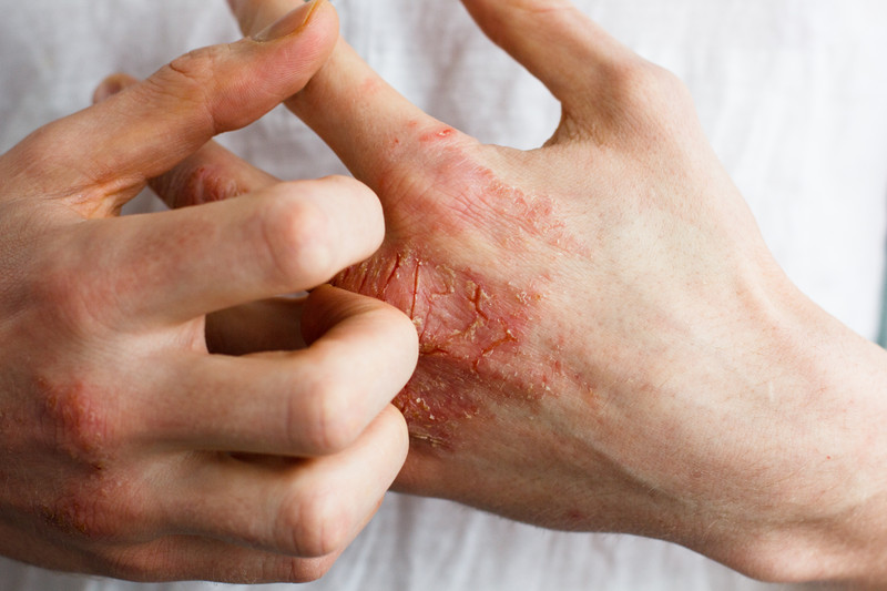 Supplements to Ease Eczema Symptoms