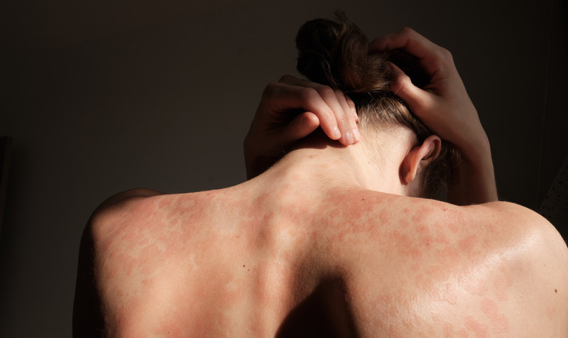 4 Natural Remedies to Help Solve Psoriasis