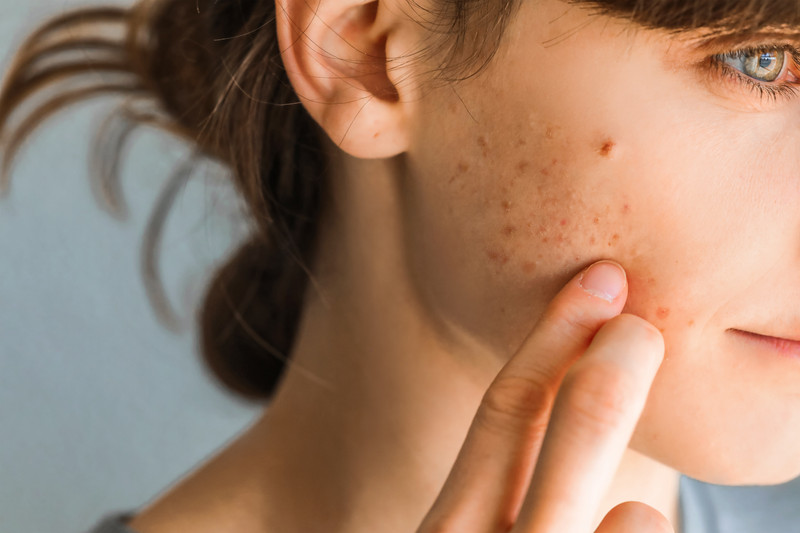 Six Advantageous Remedies for Acne Angst