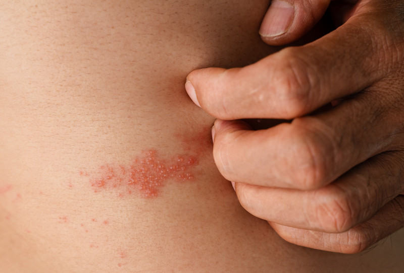 4 Natural Remedies to Prevent and Treat Shingles