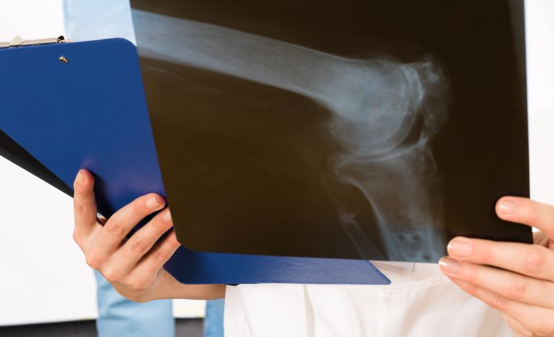 How Bone Health Is Related to Nutrition How Bone Health Is Related to Nutrition