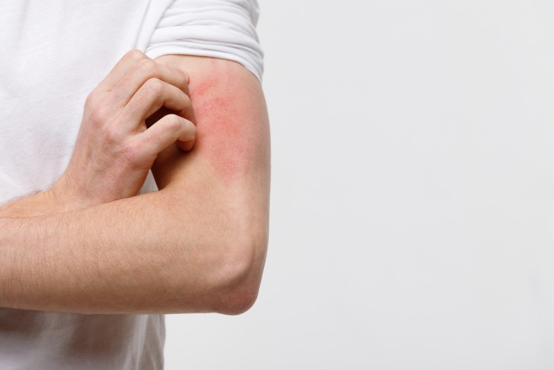 Make Scabies Scamper Away with the Right Supplements
