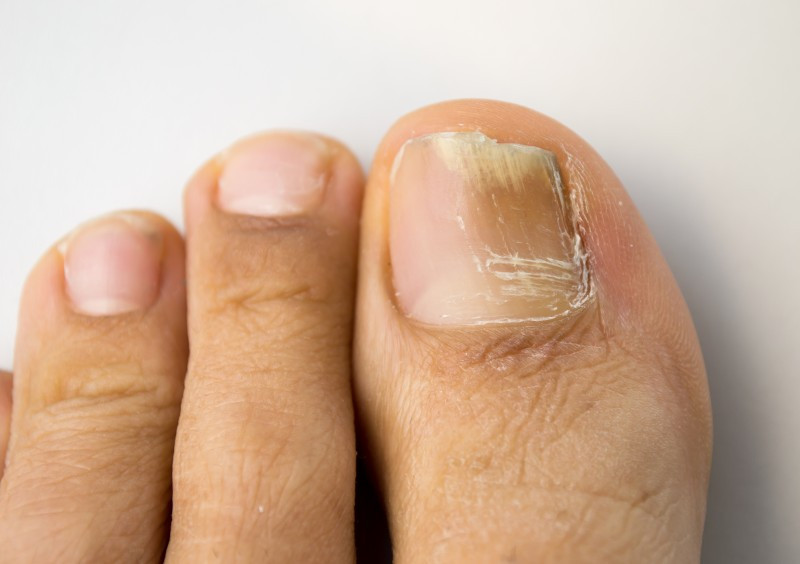 Nail Infections Need Your Intervention: Hereâ€™s How