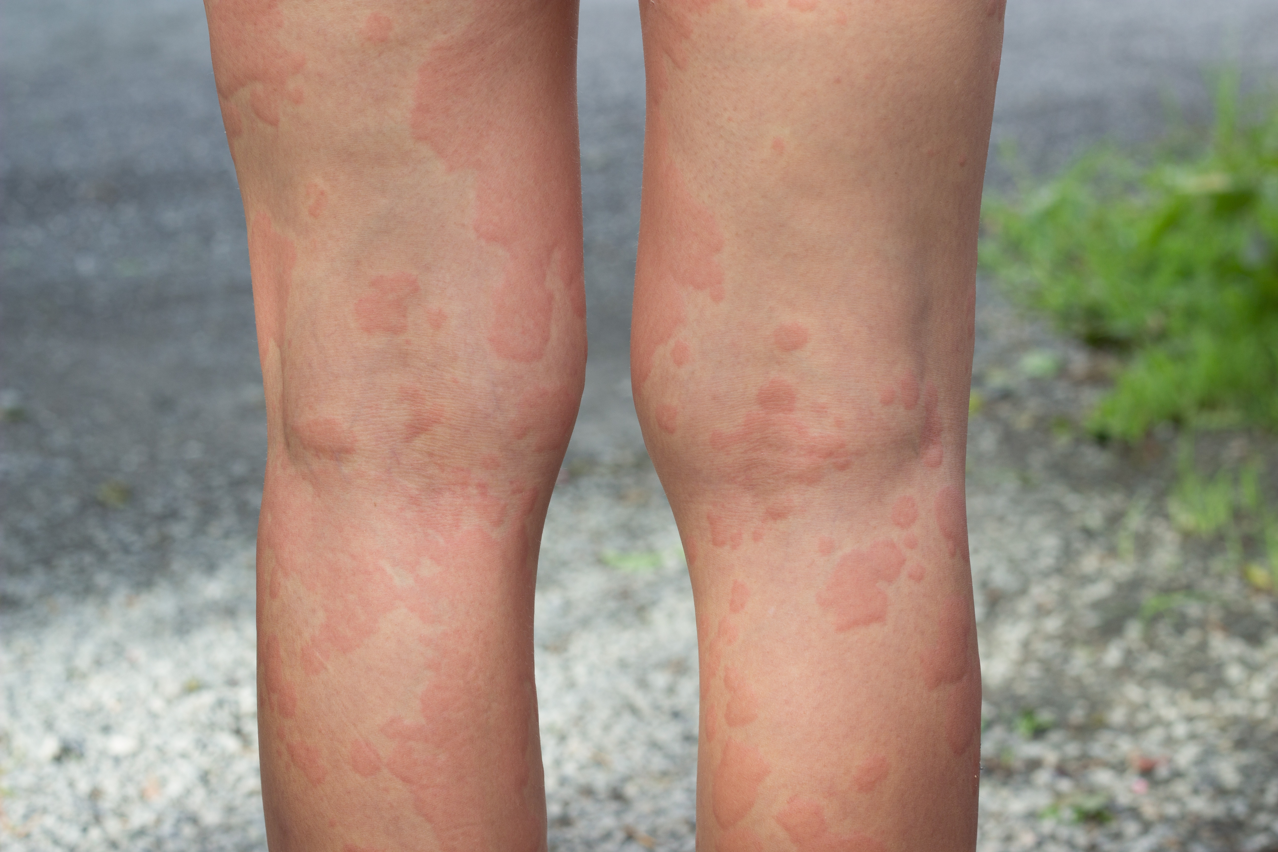 Products Which Could Help Remedy Hives