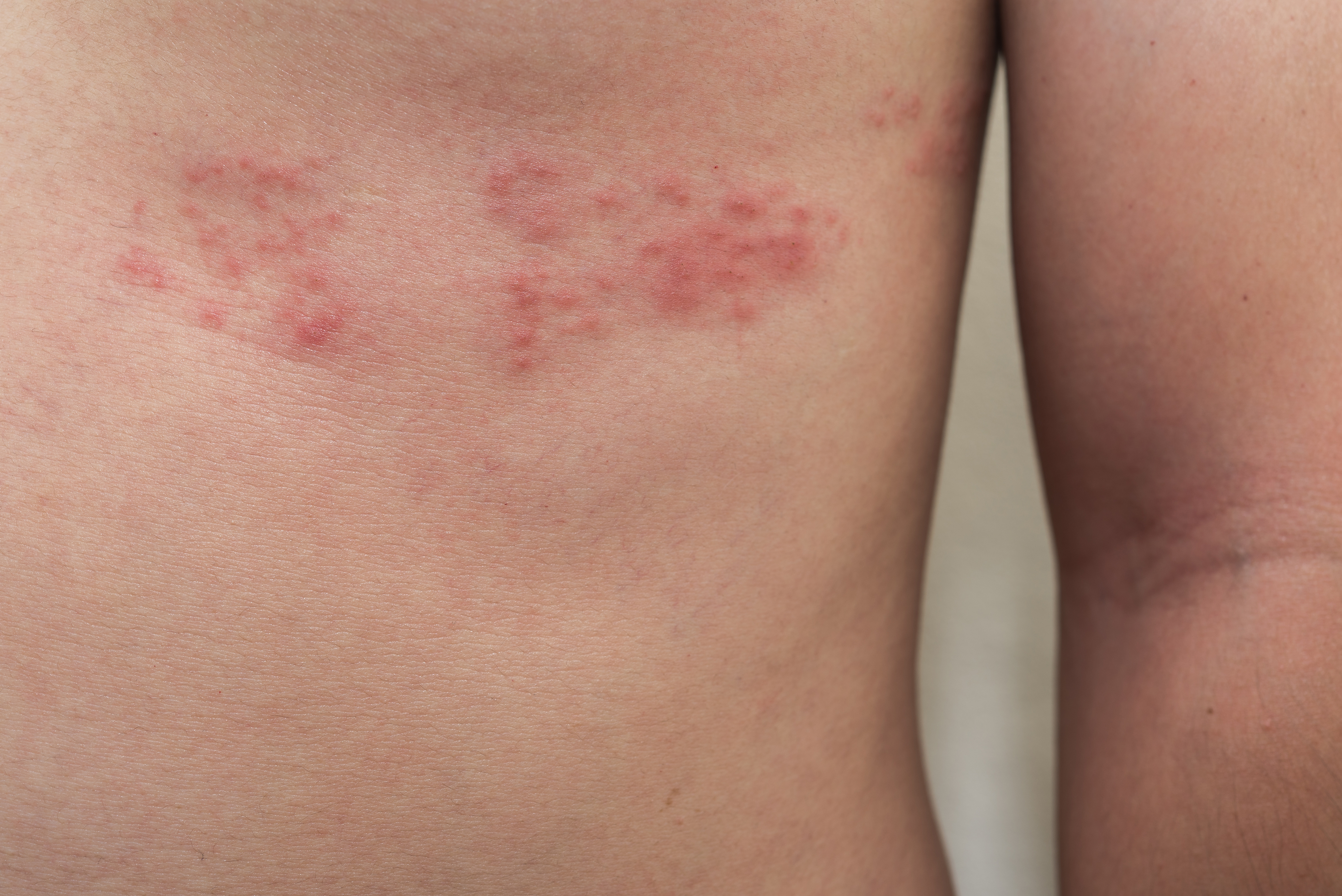 5 Products That Can Help Neutralize Shingles