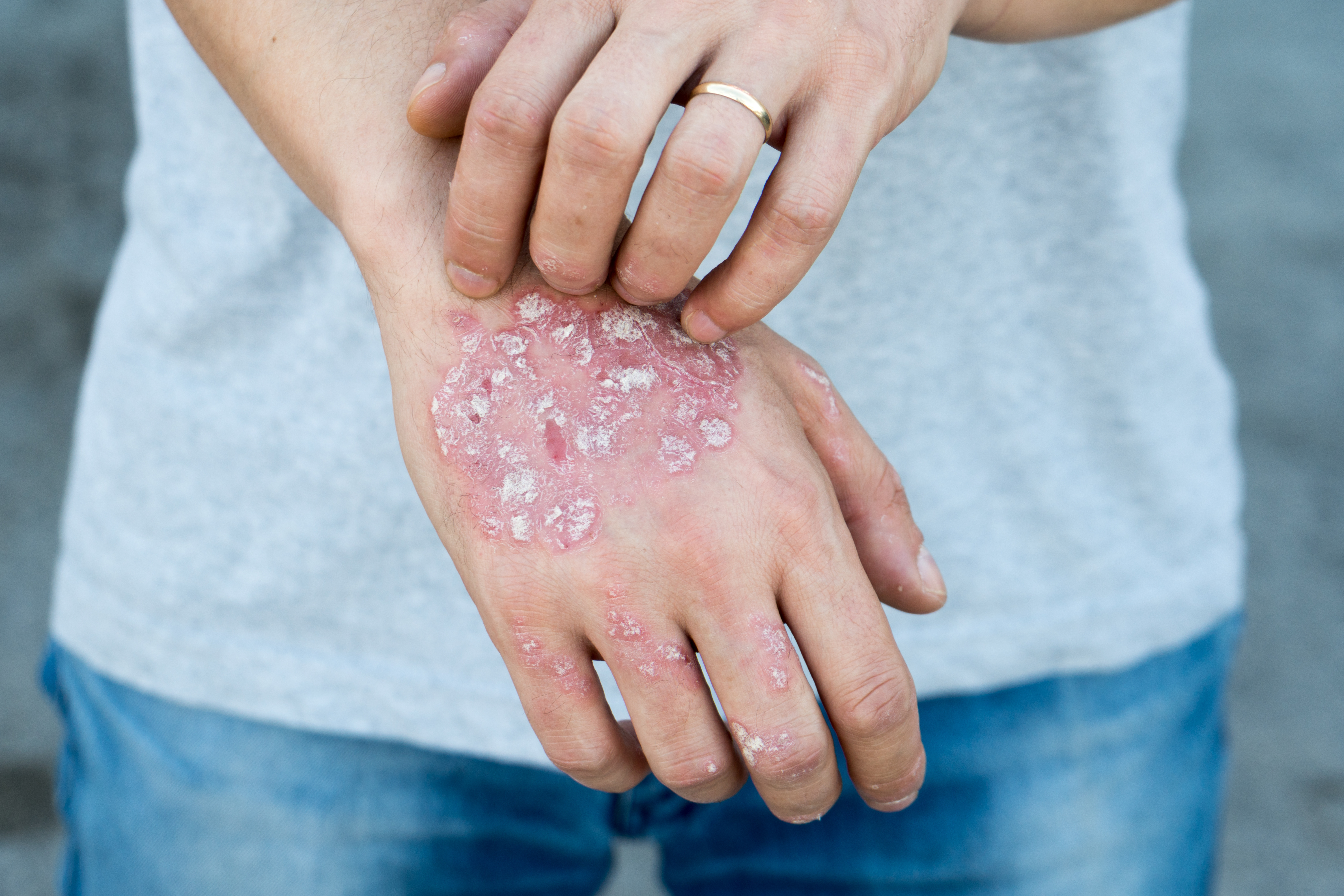 Autoimmune Diseases Supplemental Solutions, Part 1: Psoriasis