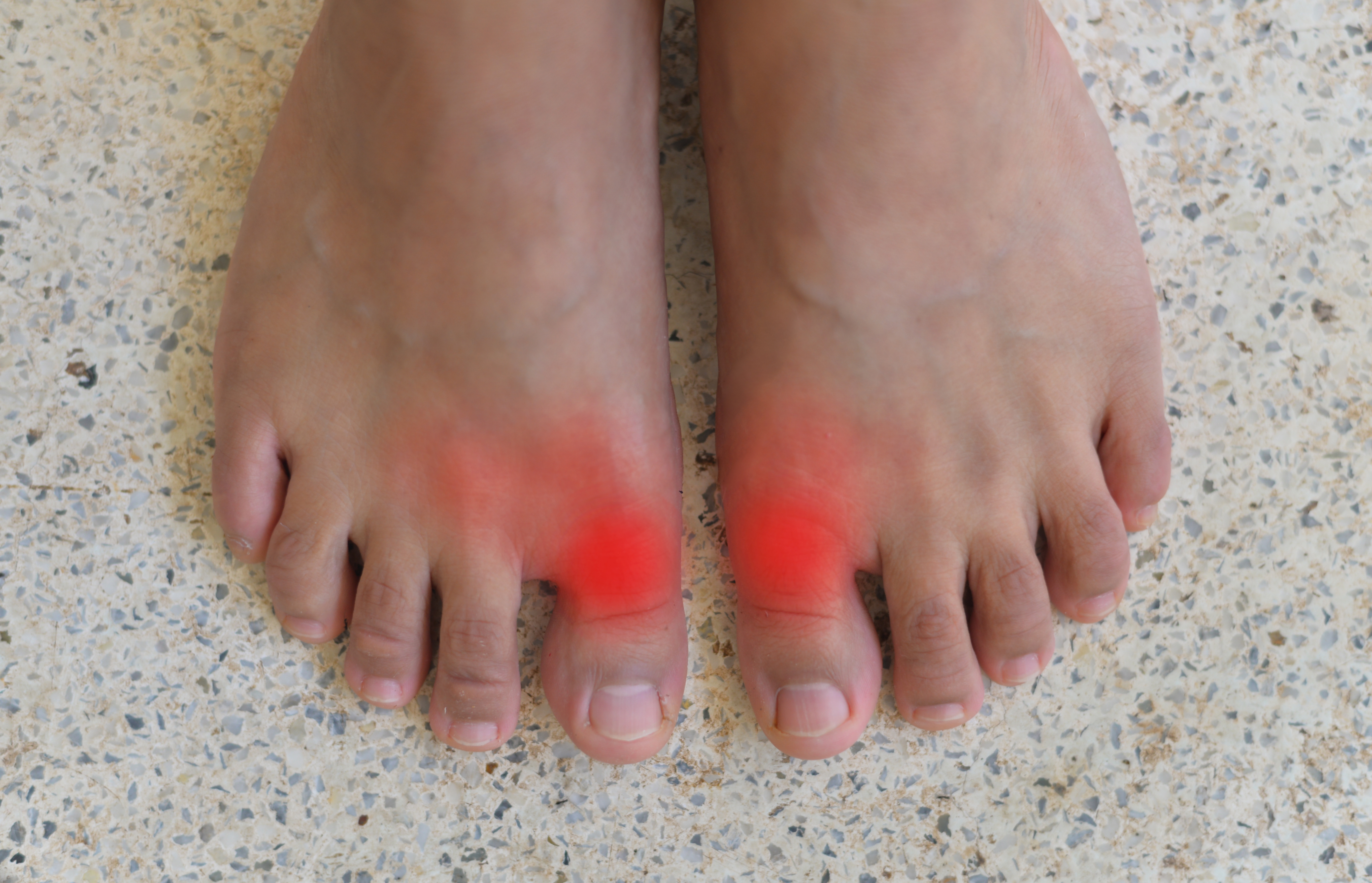 What Is Gout and How Can It Be Treated?