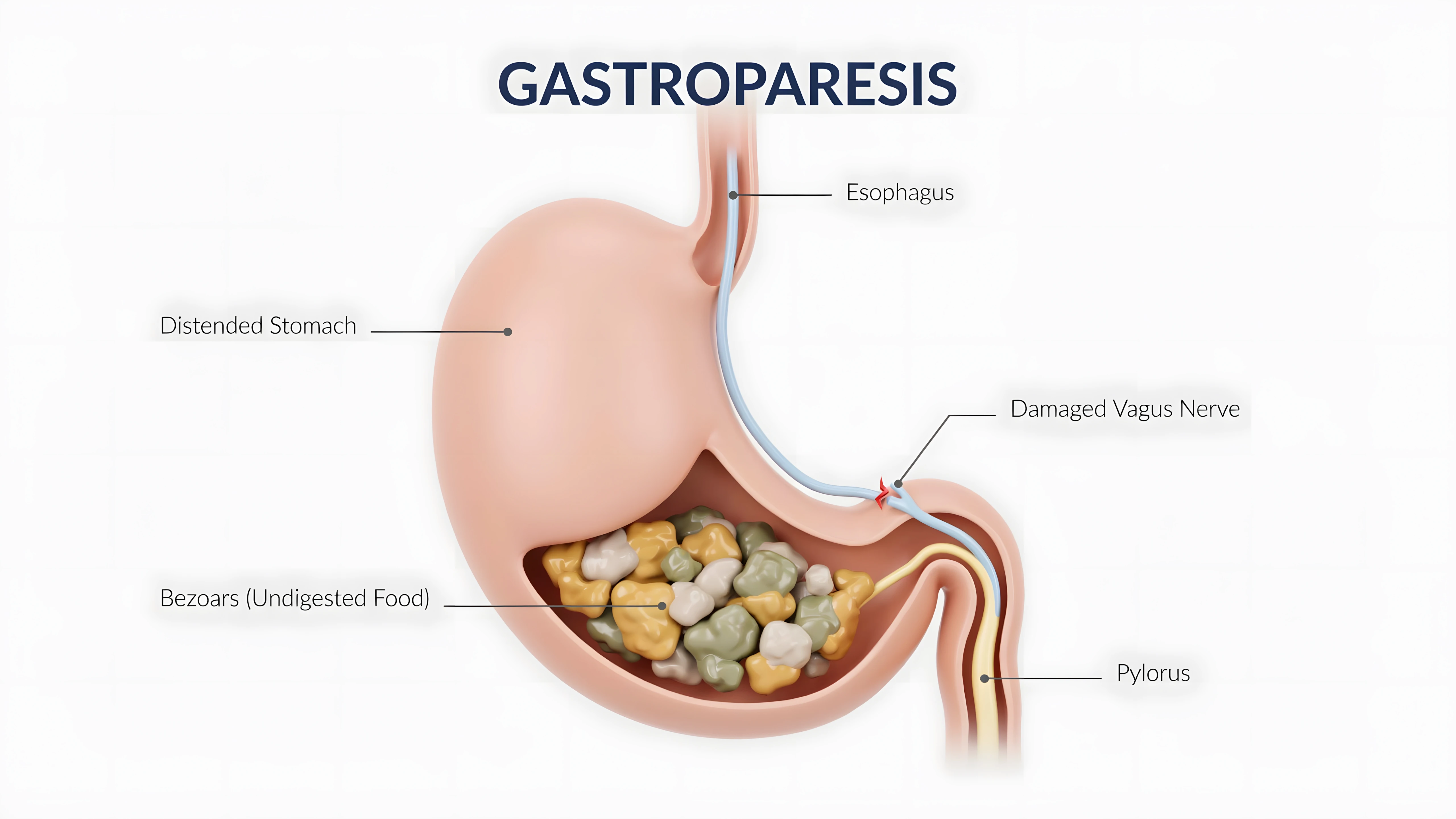 August Is Gastroparesis Awareness Month