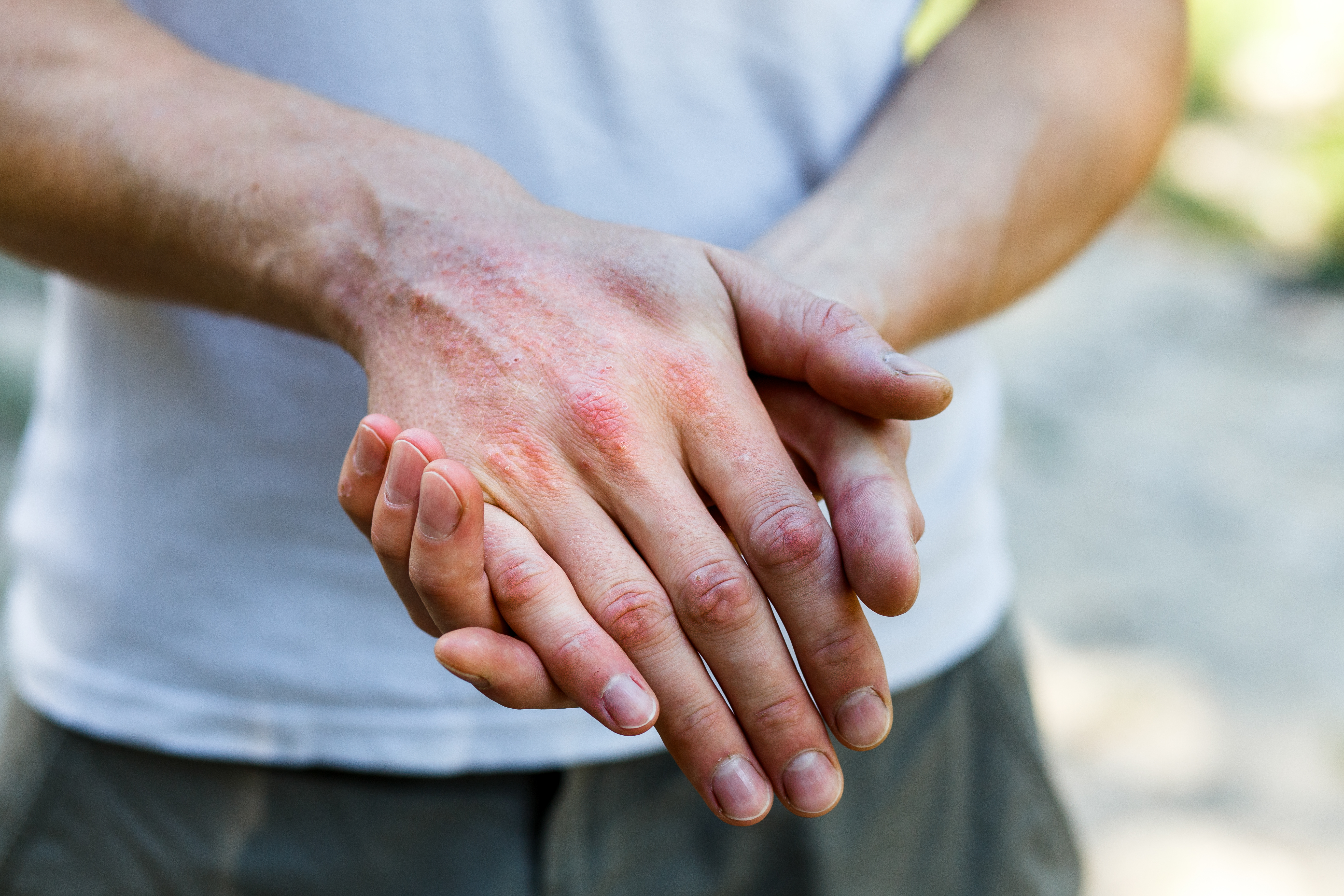 Tracking and Treating Chronic Diseases, Part XI: Eczema