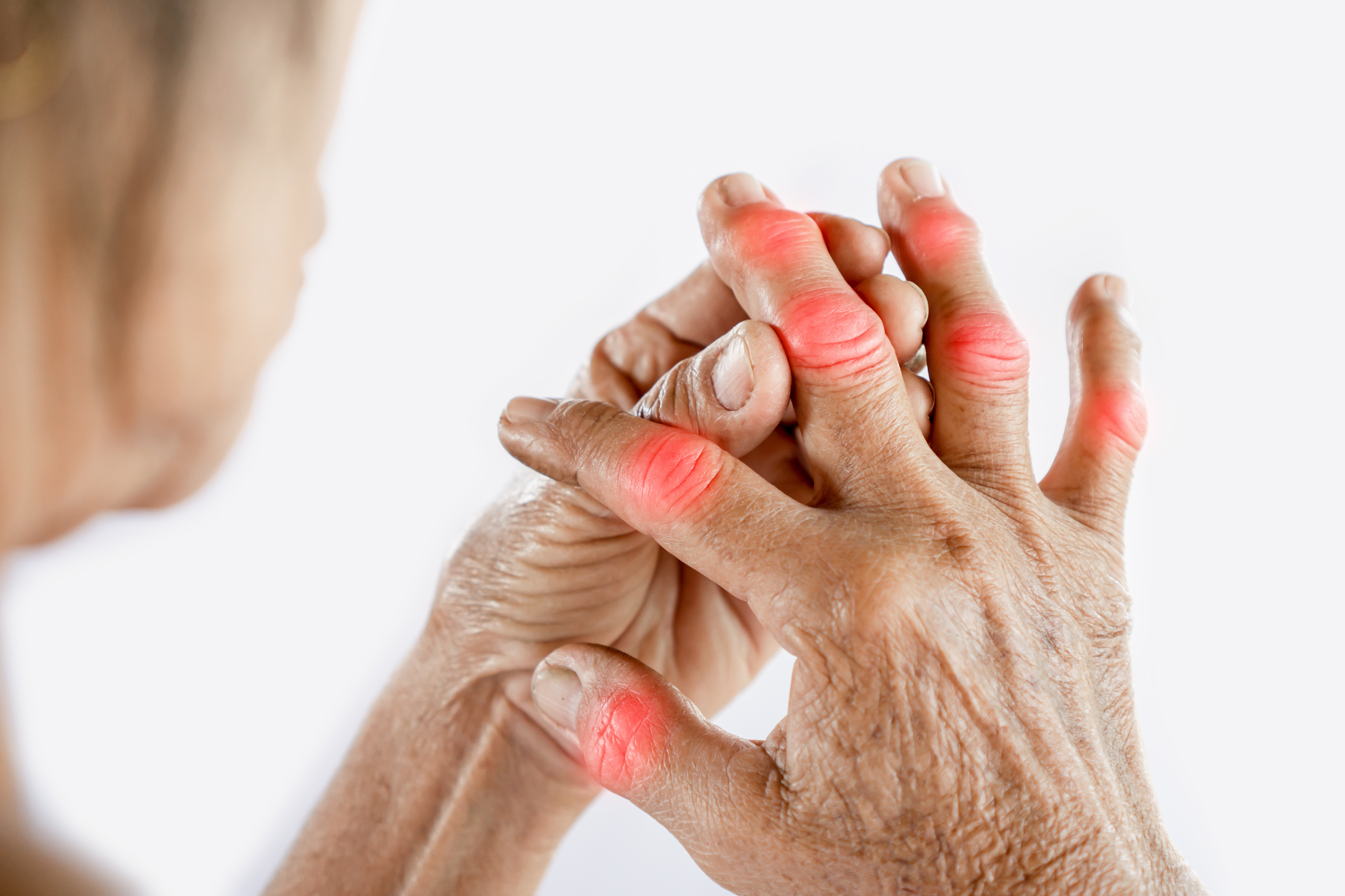 May Is Arthritis Awareness Month: 5 Supplements to Consider