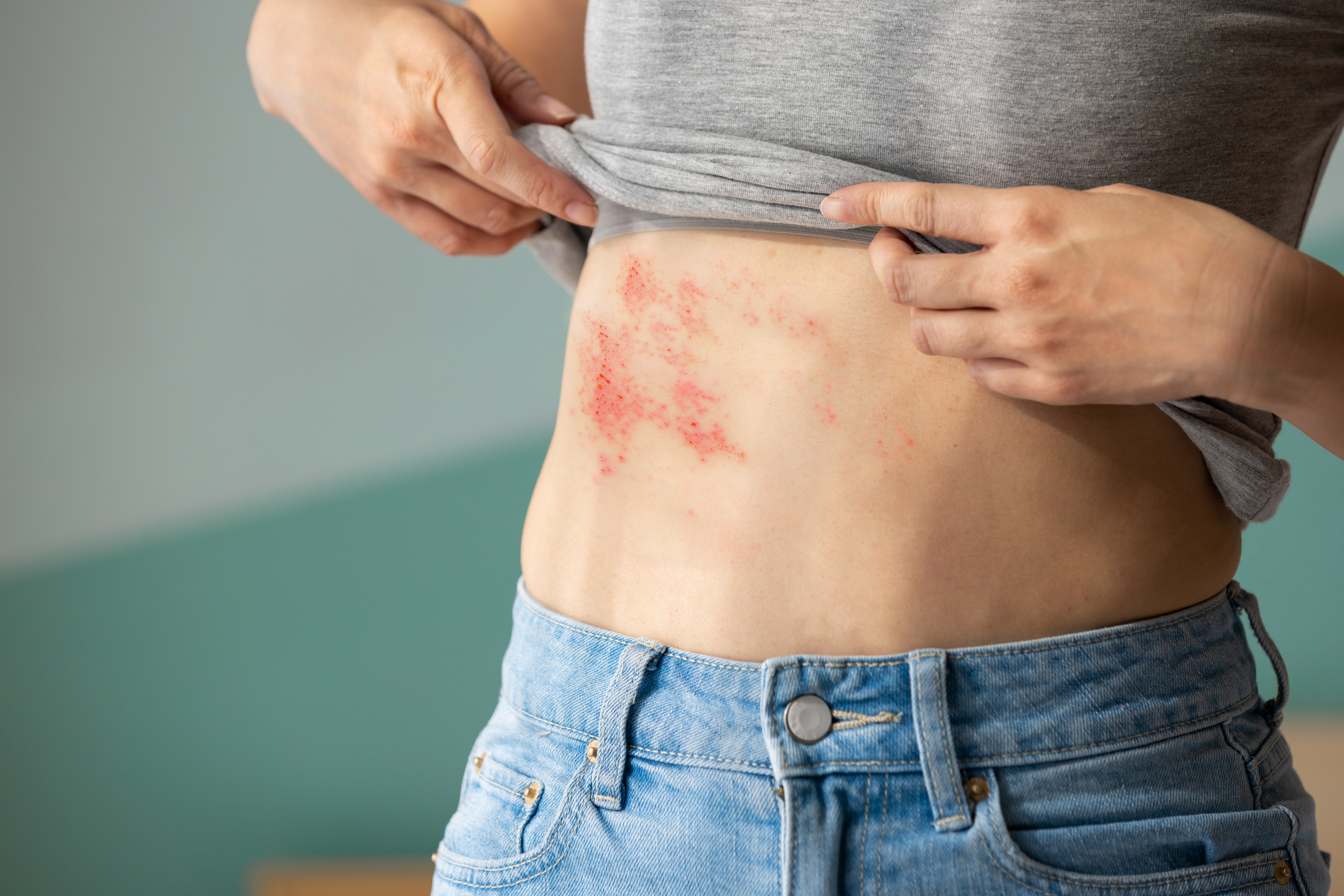 3 Suitable Supplements to Help Manage Shingles
