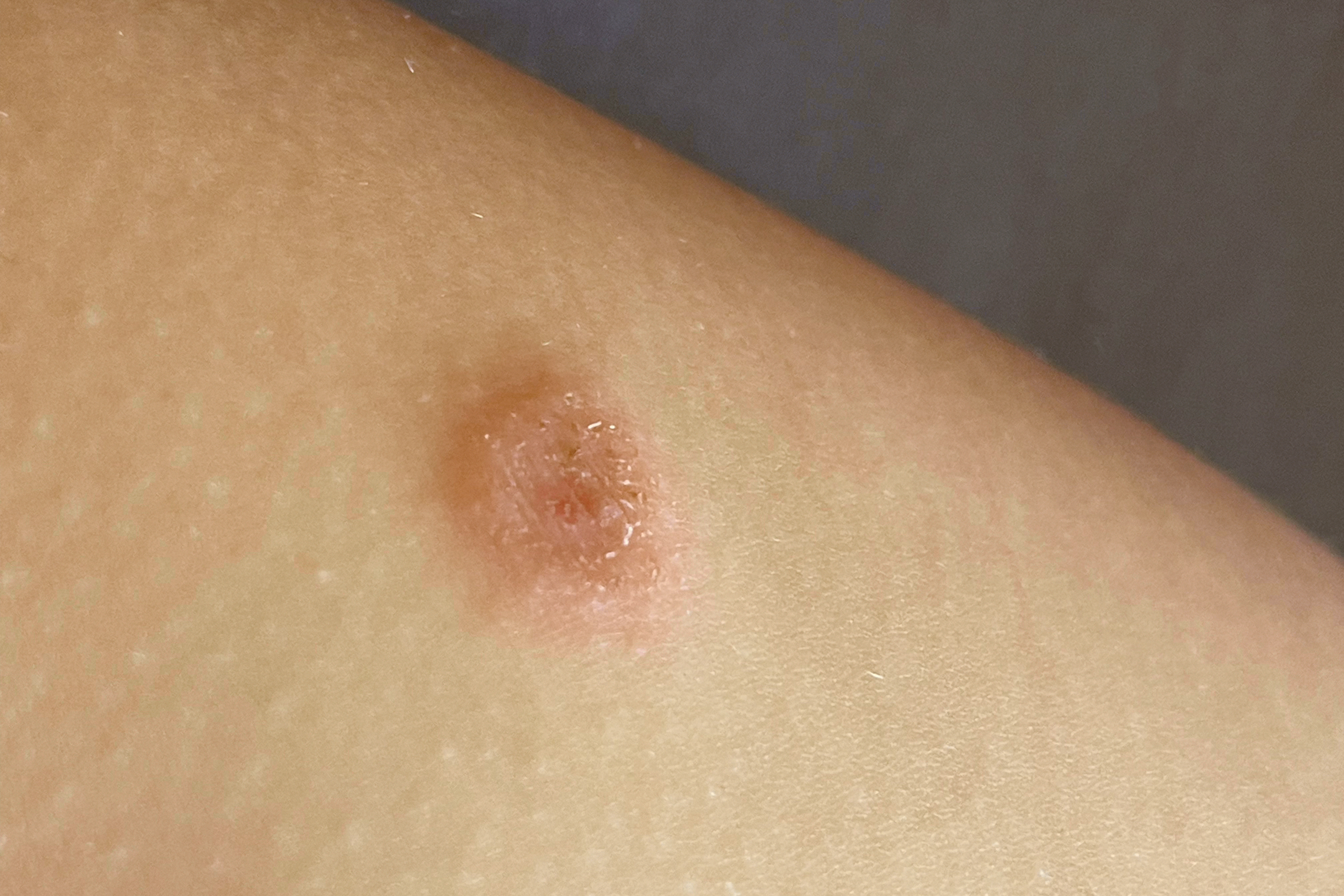 Stifle a Staph Infection with These Natural Remedies