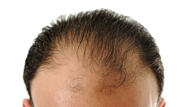 How A Lack Of Vitamins & Minerals Can Lead To Hair Loss